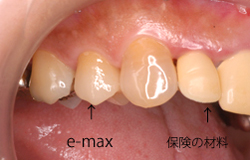 e-max