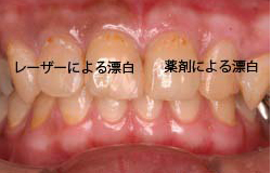 漂白後