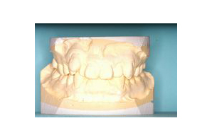 歯型模型