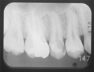根の治療 レントゲン