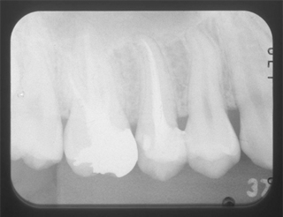 根の治療 レントゲン02