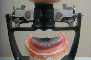 ゴシックアーチ、チェックバイト