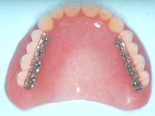 メタルブレードティース