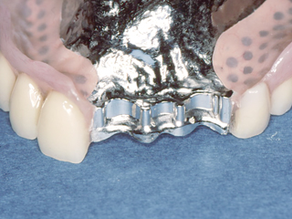 リングデンチャー