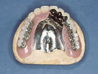 リングデンチャー02